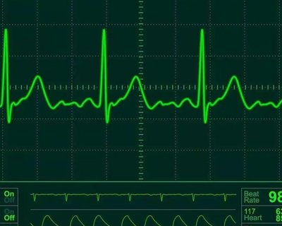 Electrocardiogram (ECG) measurement